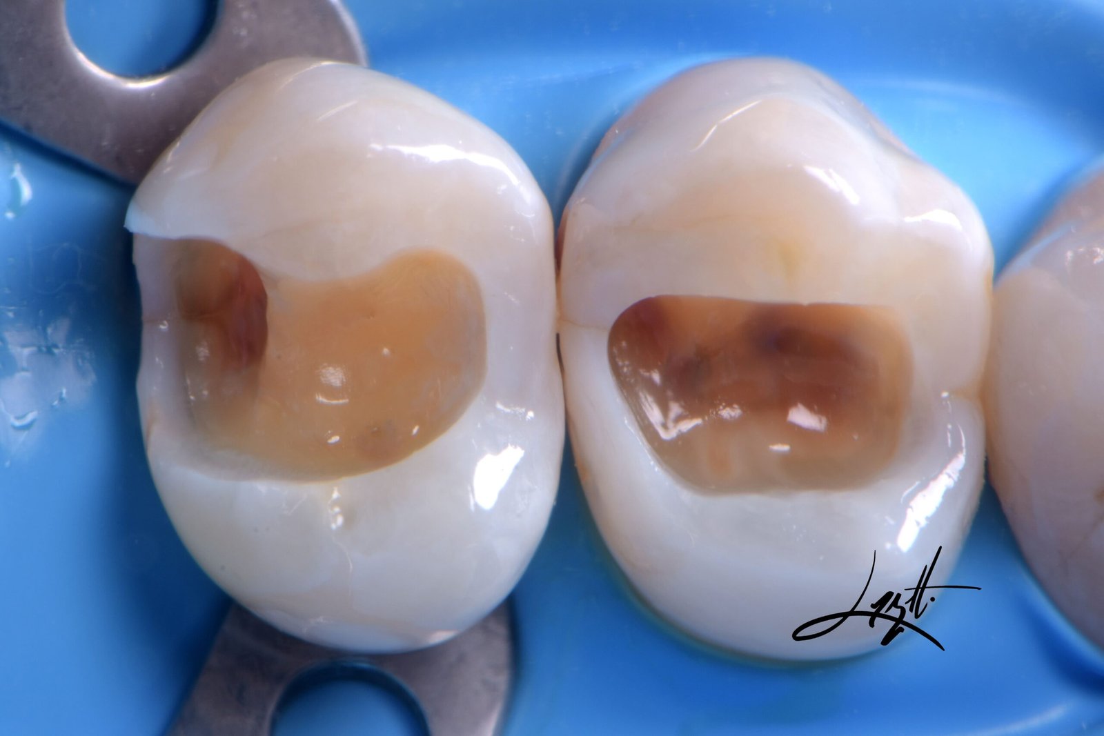 Dentista em porto alegre restauracao resina porcelana restaurar dente estetica dos dentes estetica em porto alegre (3) Dentista em porto alegre restauracao resina porcelana restaurar dente estetica dos dentes estetica em porto alegre (3)