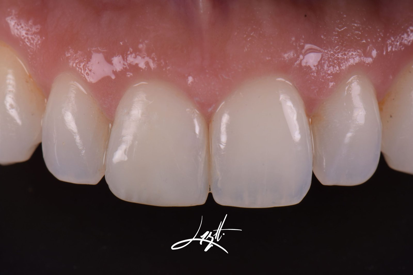 Dentista-em-porto-alegre-restauracao-resina-porcelana-restaurar-dente-estetica-dos-dentes-estetica-em-porto-alegre-3666 (1)44