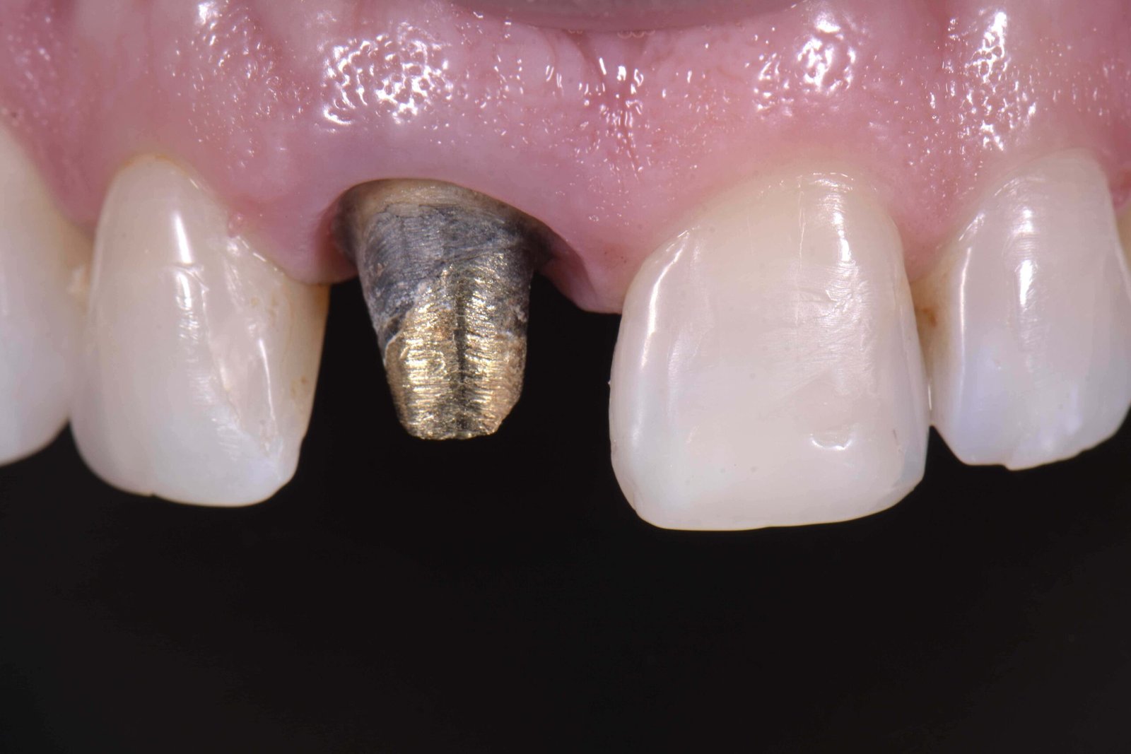 Dentista em porto alegre restauracao resina porcelana restaurar dente estetica dos dentes estetica em porto alegre (3888) copiar Dentista em porto alegre restauracao resina porcelana restaurar dente estetica dos dentes estetica em porto alegre (3888) copiar