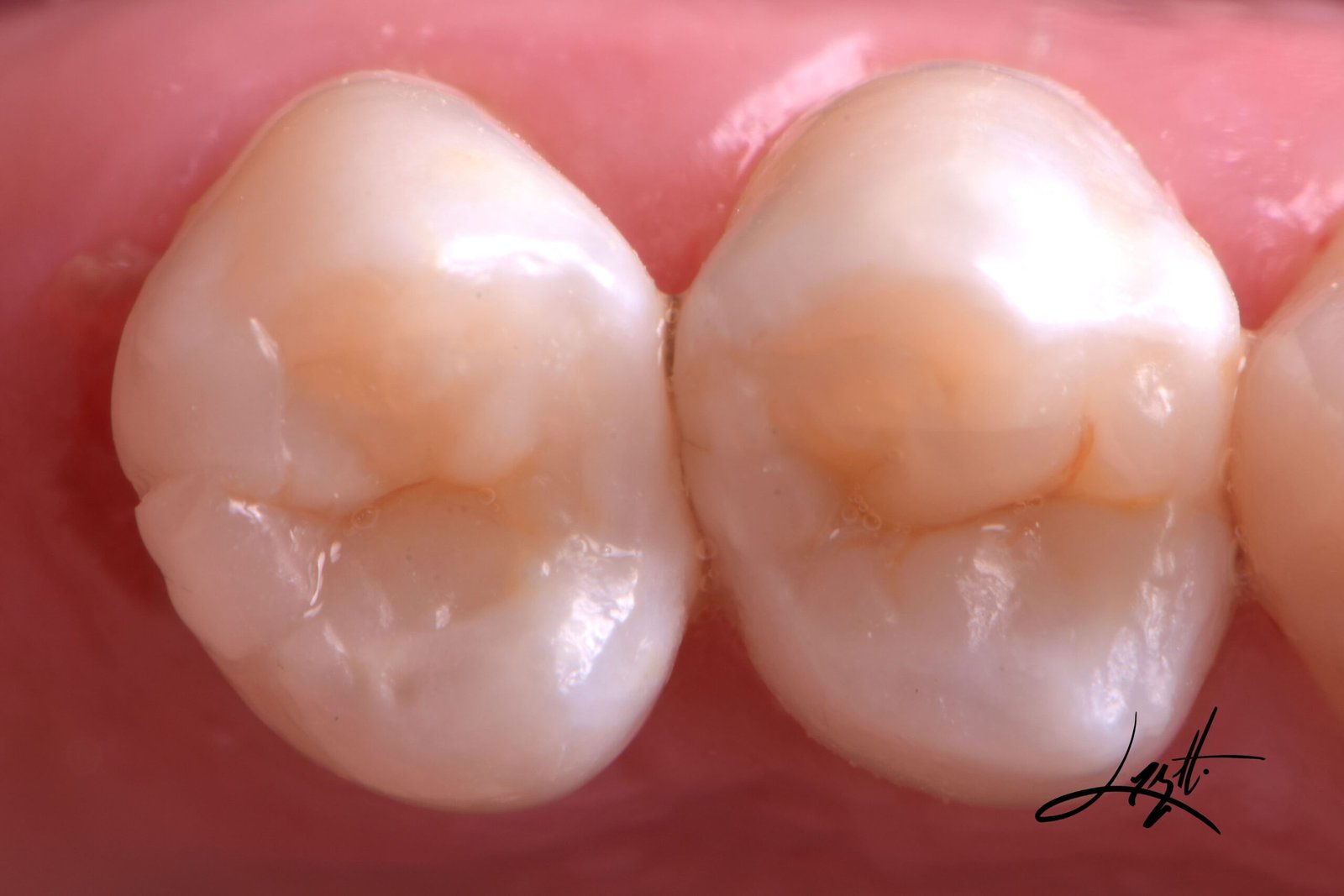 Dentista em porto alegre restauracao resina porcelana restaurar dente estetica dos dentes estetica em porto alegre (4) Dentista em porto alegre restauracao resina porcelana restaurar dente estetica dos dentes estetica em porto alegre (4)