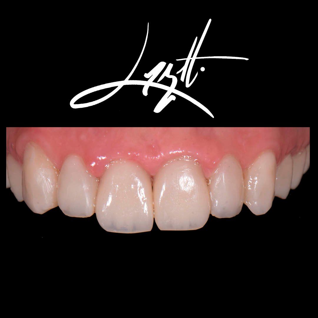 Dentista em porto alegre restauracao resina porcelana restaurar dente estetica dos dentes estetica em porto alegreres Dentista em porto alegre restauracao resina porcelana restaurar dente estetica dos dentes estetica em porto alegreres