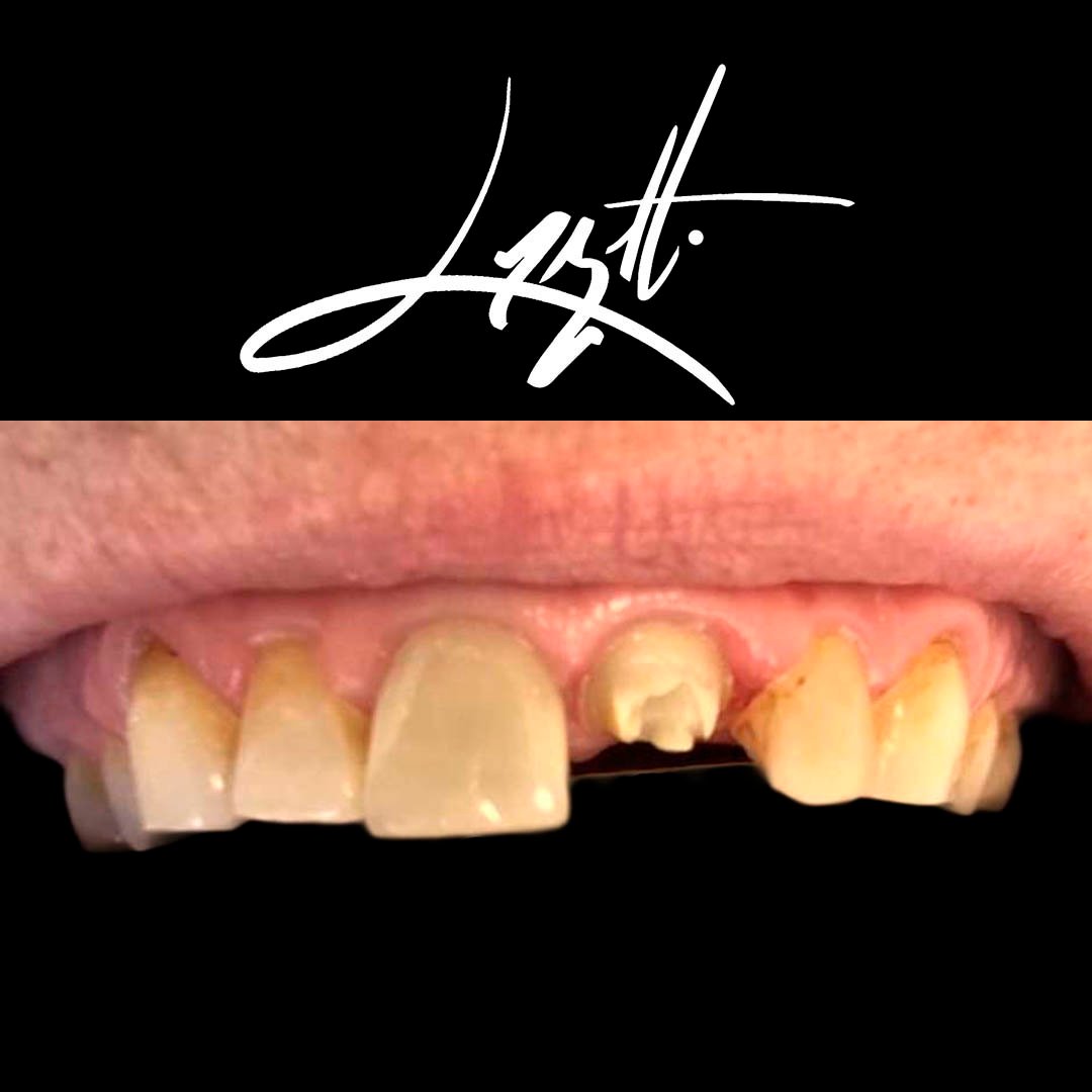 Dentista em porto alegre restauracao resina porcelana restaurar dente estetica dos dentes estetica em porto alegres copia56r5 Dentista em porto alegre restauracao resina porcelana restaurar dente estetica dos dentes estetica em porto alegres copia56r5